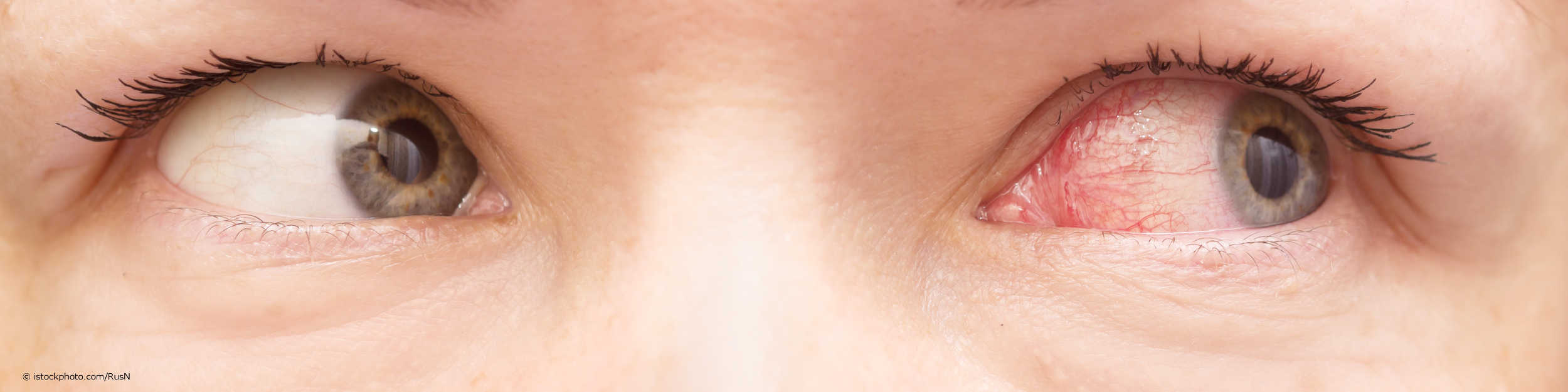 Gerötete Augen sind typische Symptome einer Bindehautentzündung.