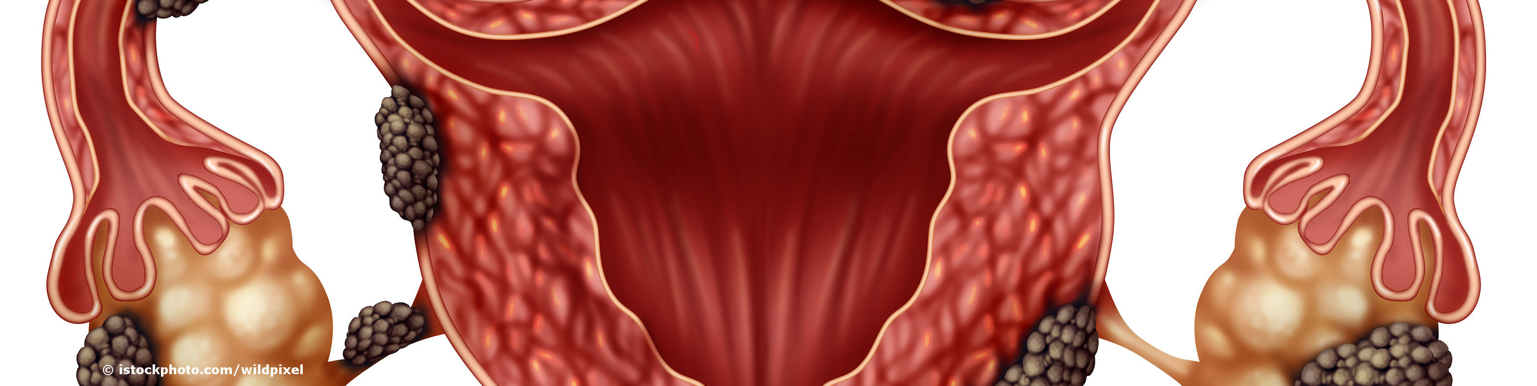 Gebärmutter (Uterus) mit Endometrioseherden in Eierstöcken, Eileitern und Gebärmutterwand.