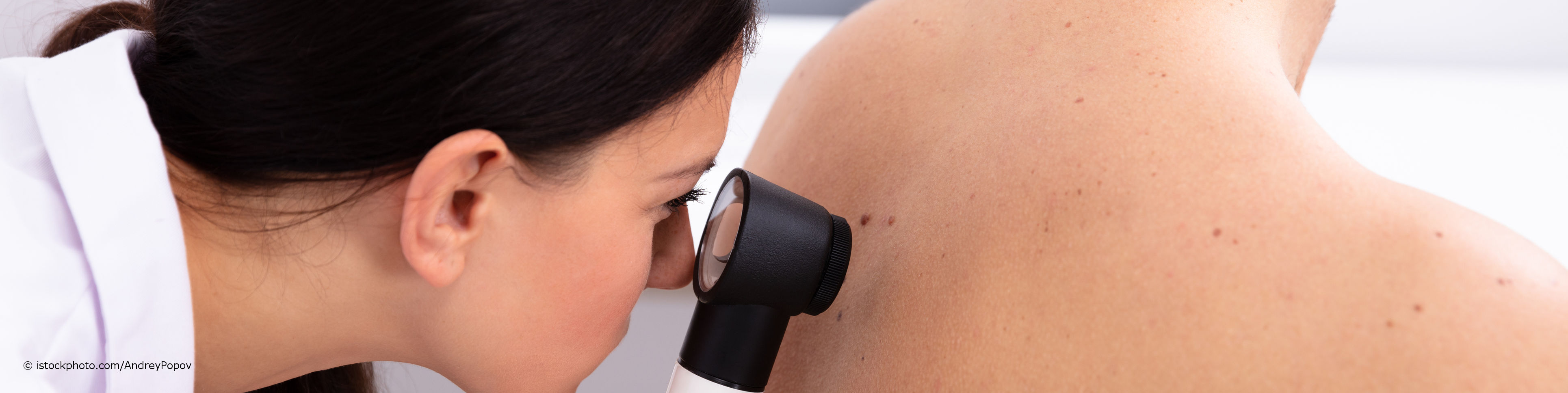Eine Hautärztin untersucht im Rahmen der Hautkrebs-Früherkennung mit einem Dermatoskop die Leberflecken auf dem Rücken eines Patienten